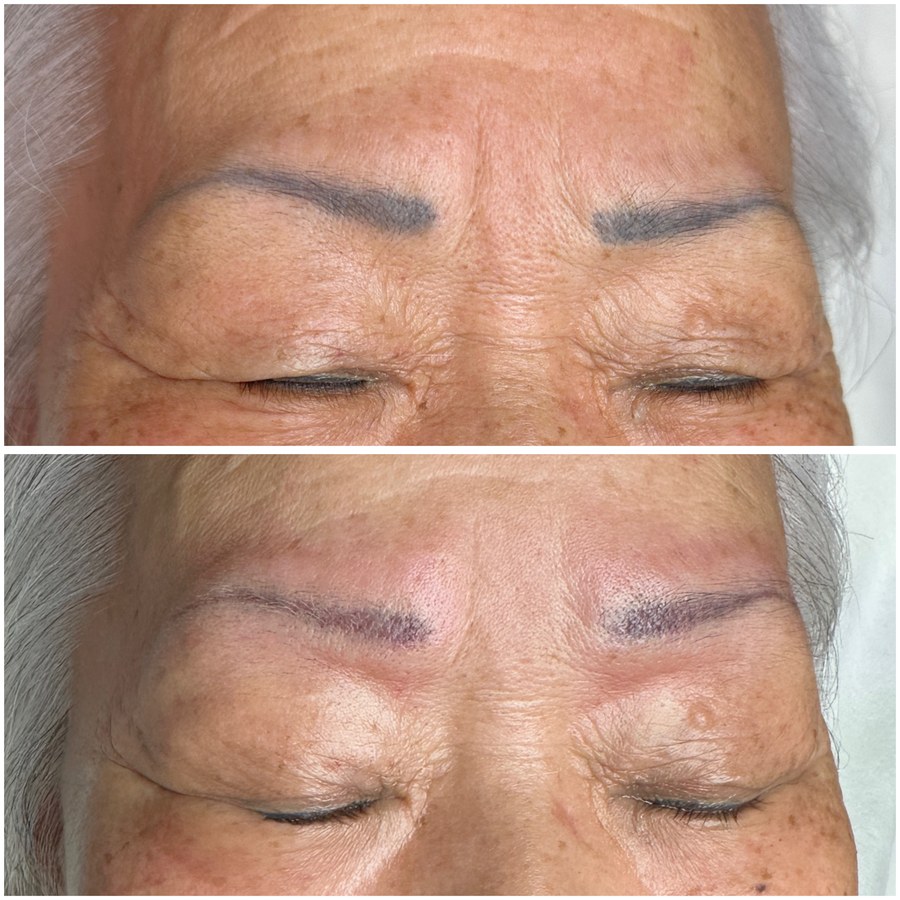 Before and after eyebrow pigment removal: cool grey-blue tattooed brows above, lightened and softened below