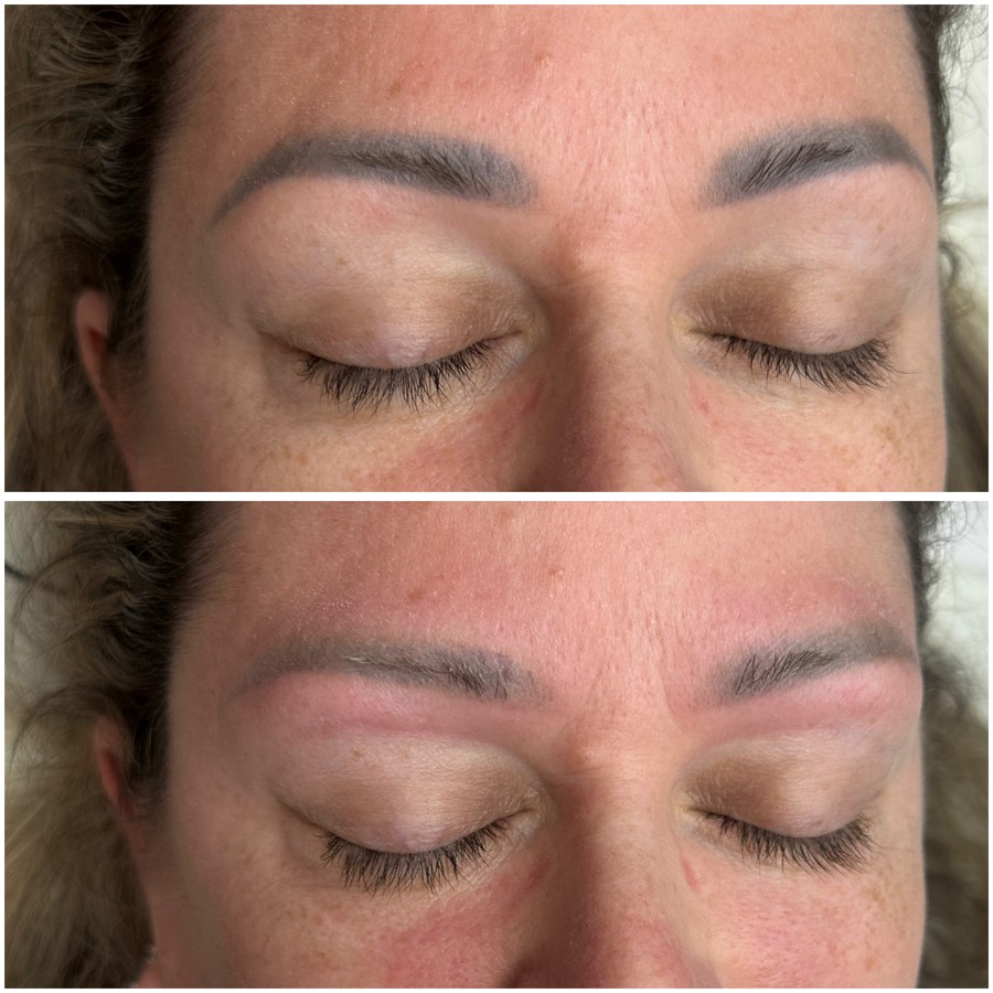 Before and after eyebrow pigment removal: dark saturated grey-brown brows above, mostly cleared with natural hair below