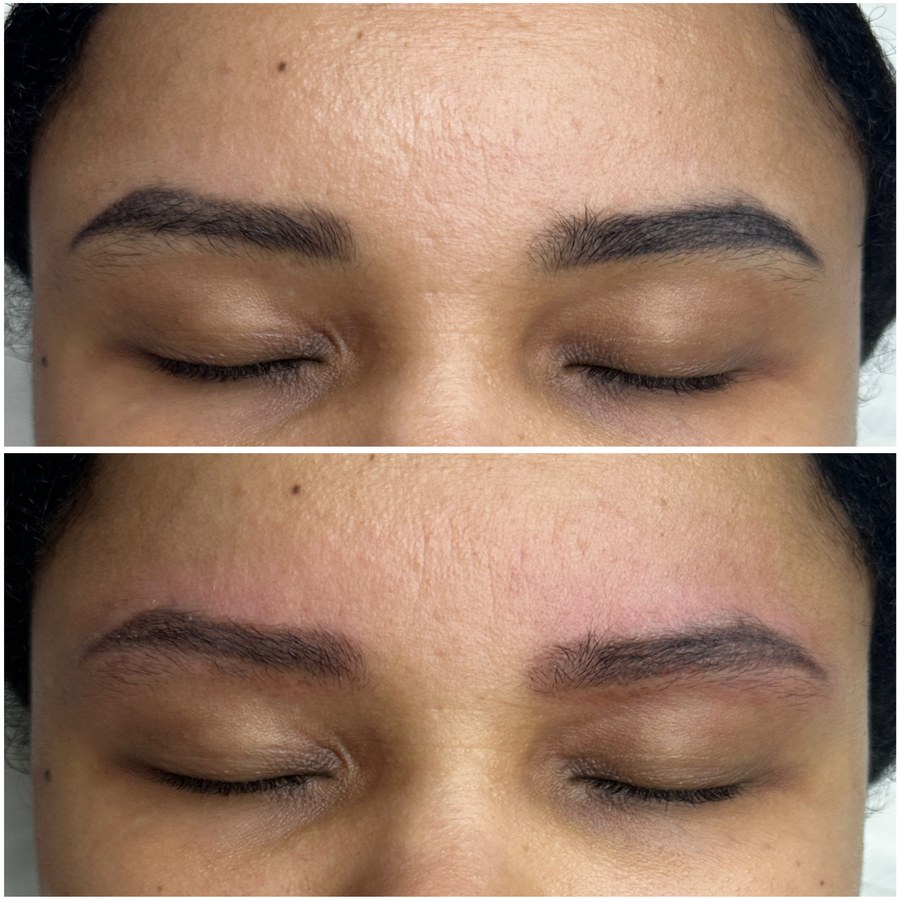 Before and after eyebrow pigment removal: dark blocky tattooed brows above, softened and lightened below